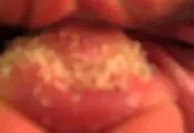 Pushing Out The Blackheads
