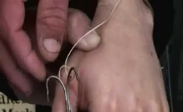 Removing A Treble Hook From A Man’s Hand